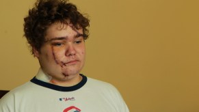 Andrew Wegrzyn of Chicago, Illinois, shows his facial and scalp injuries he sustained in a car accident in 2011